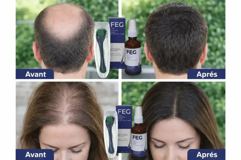 FEG Plus – Solution Avancée pour la Croissance des Cheveux.